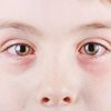Binocular Vision Disfunction