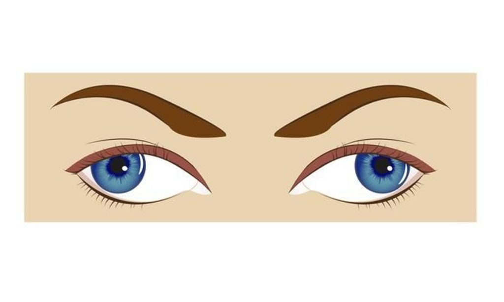 Ilustrasi strabismus atau mata juling