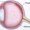 Eye Floaters