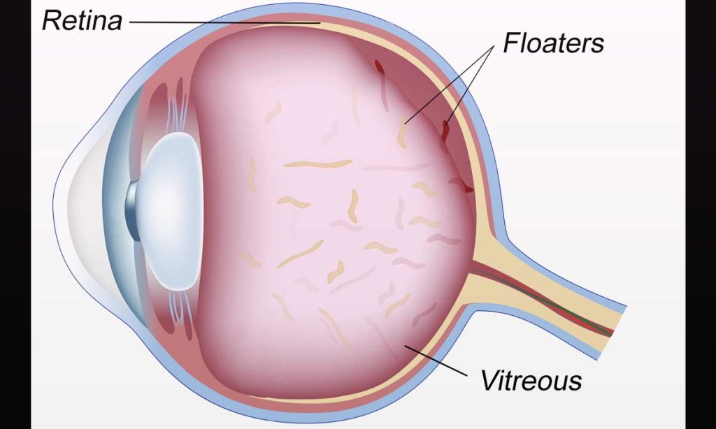 Eye Floaters