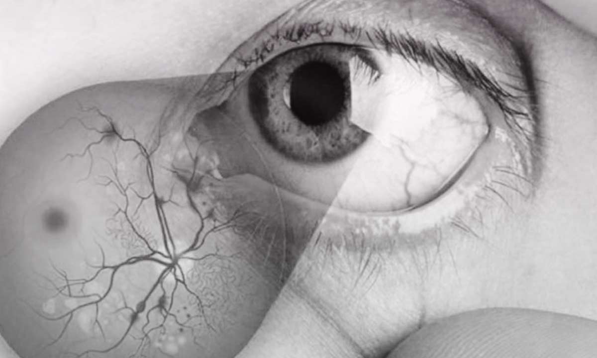 Retinopati Diabetik