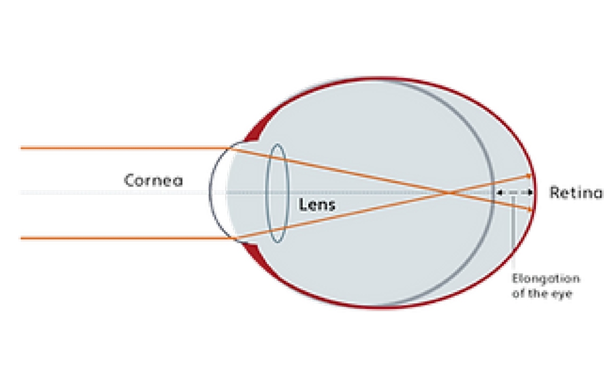 Jenis-jenis myopia